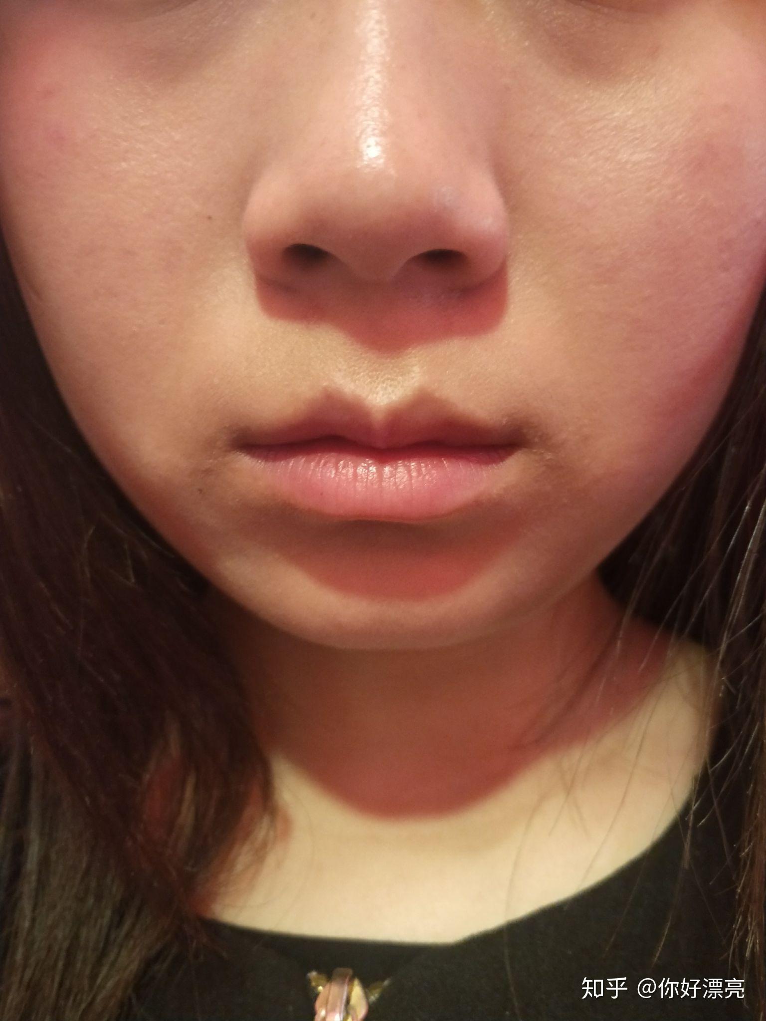 嘴唇不对称怎么办