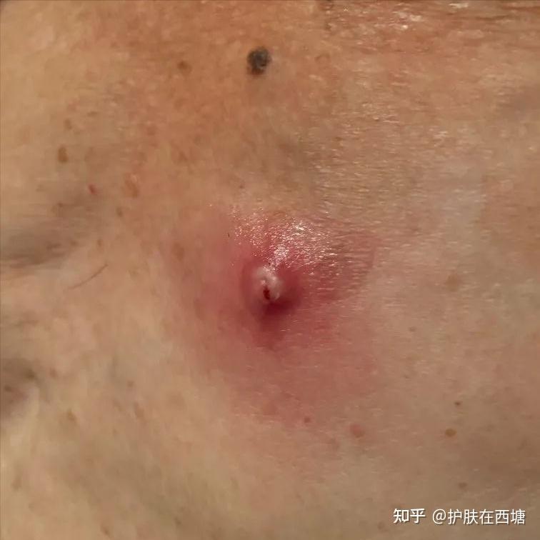 并非一般的痘痘和毛囊炎——毛囊闭锁三联症 - 知乎