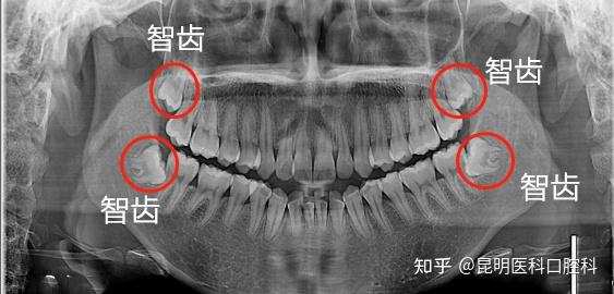 不拔智齿的好处有哪些?