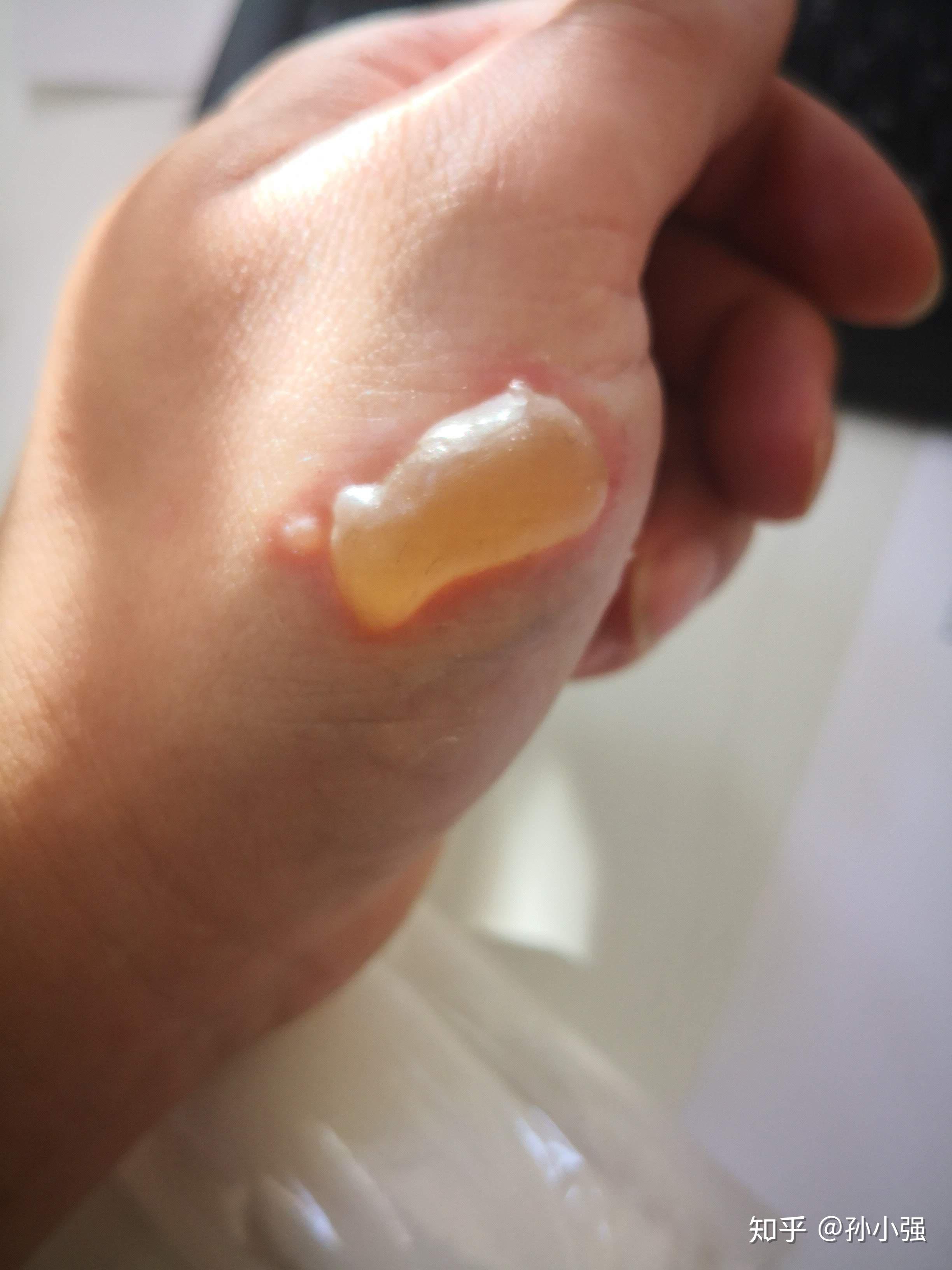 烫伤后起的泡应该弄破么