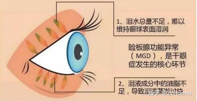 睑板腺功能障碍了怎么办？ - 知乎
