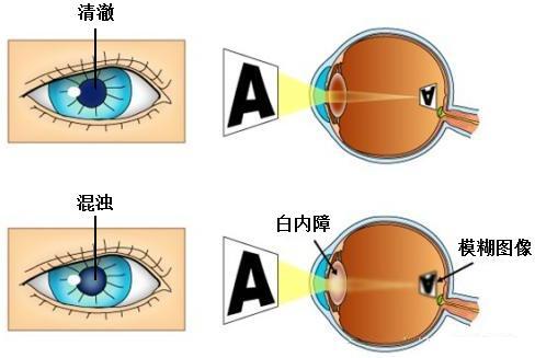 白内障手术是怎么做的？白内障手术复杂吗？ - 知乎