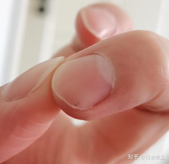 头发扎进指甲缝里怎么弄出来?
