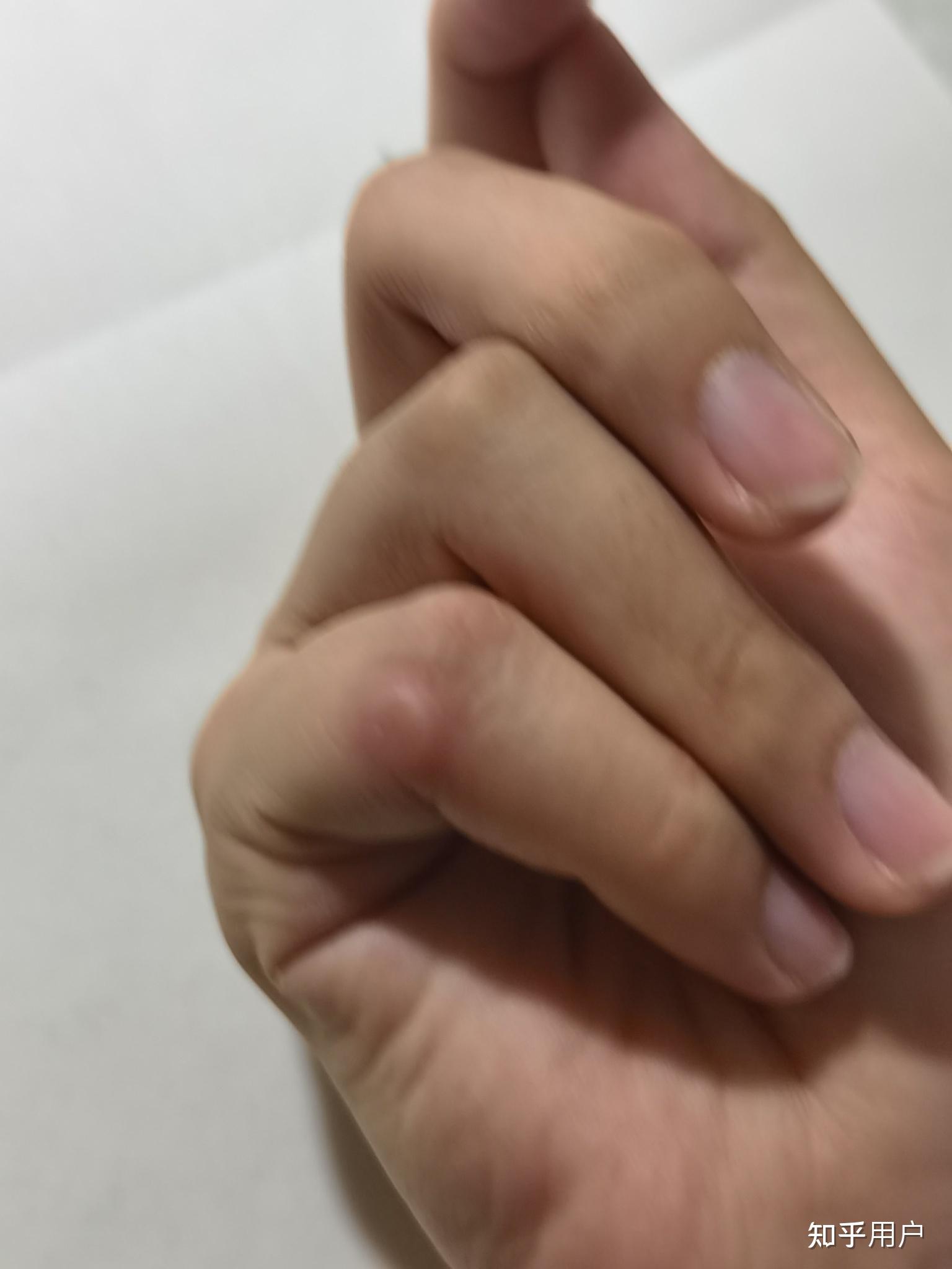 写字磨出的茧子怎么去掉? - 知乎