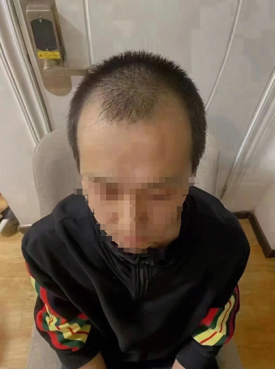植发怎么找工作(植发上班怎么让人看不出来)