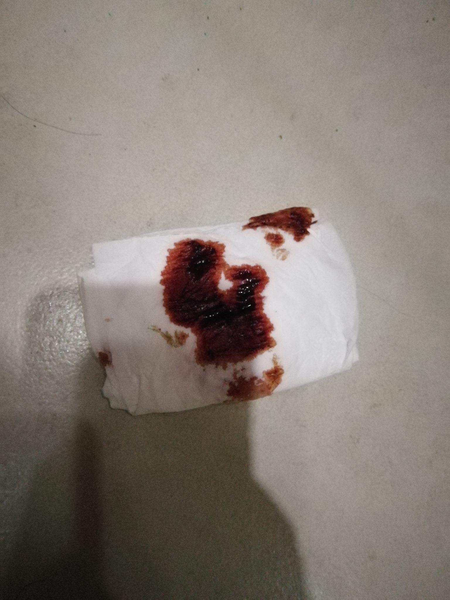 经常锻炼的女生在非经期时有咖啡色分泌物伴有大姨妈感觉应该如何处理