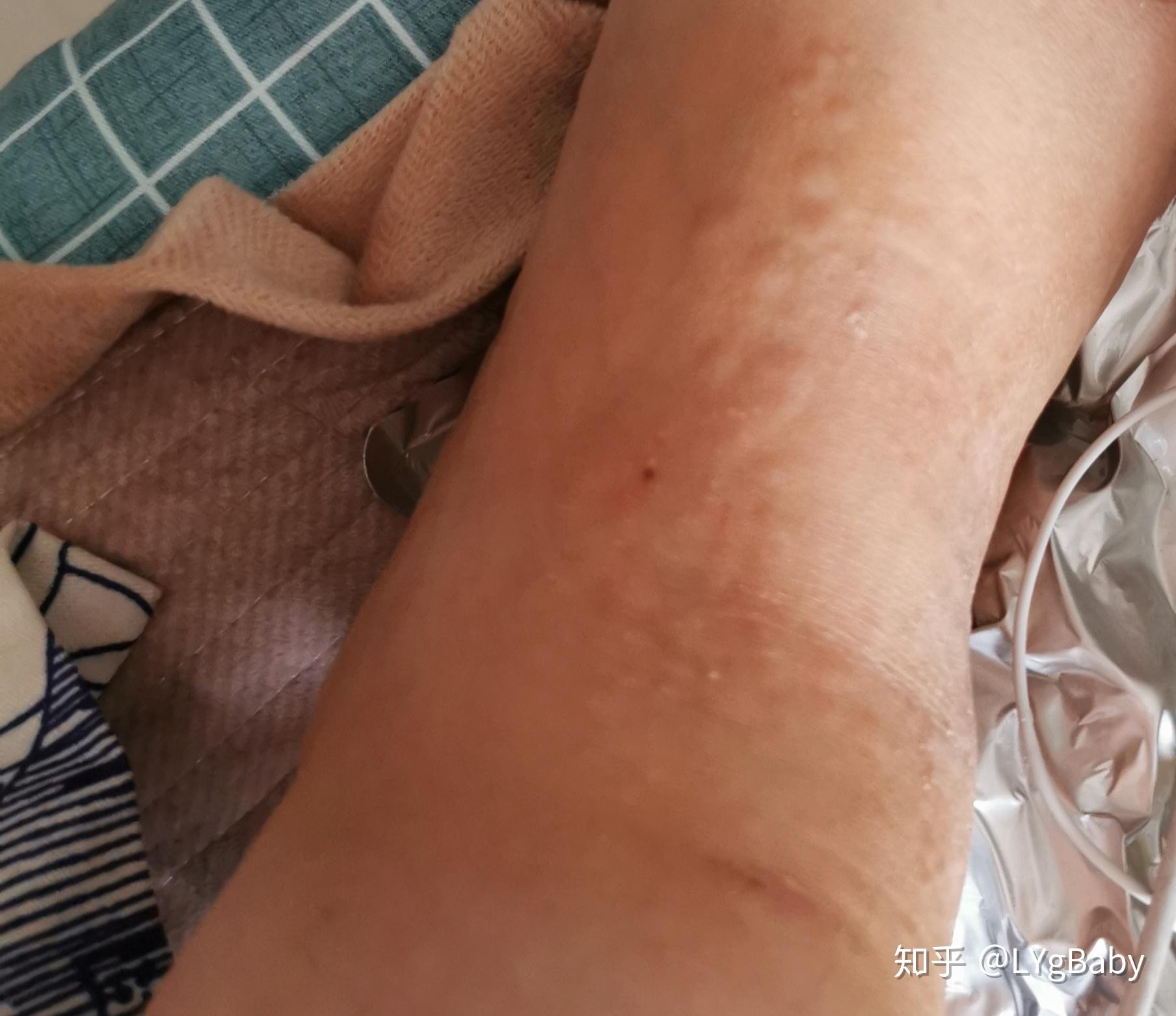 过敏会起水泡吗 知乎