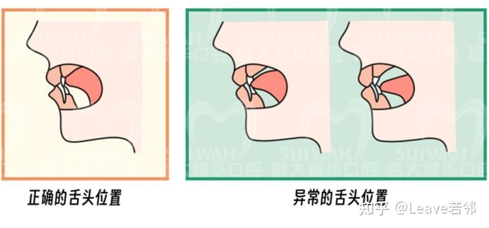 涨知识!舌头放错位置竟影响牙齿和颜值?快看看你的舌头放对了吗? - 知乎