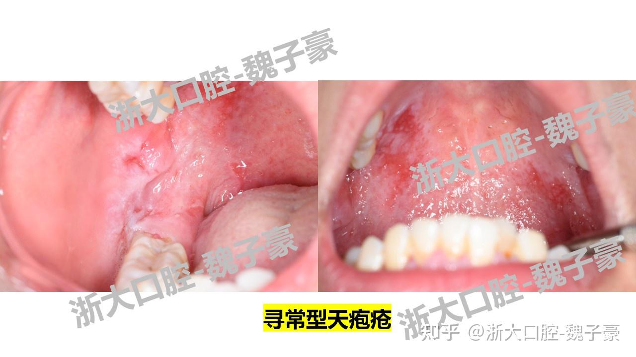 口腔黏膜大疱类疾病 简介 - 知乎