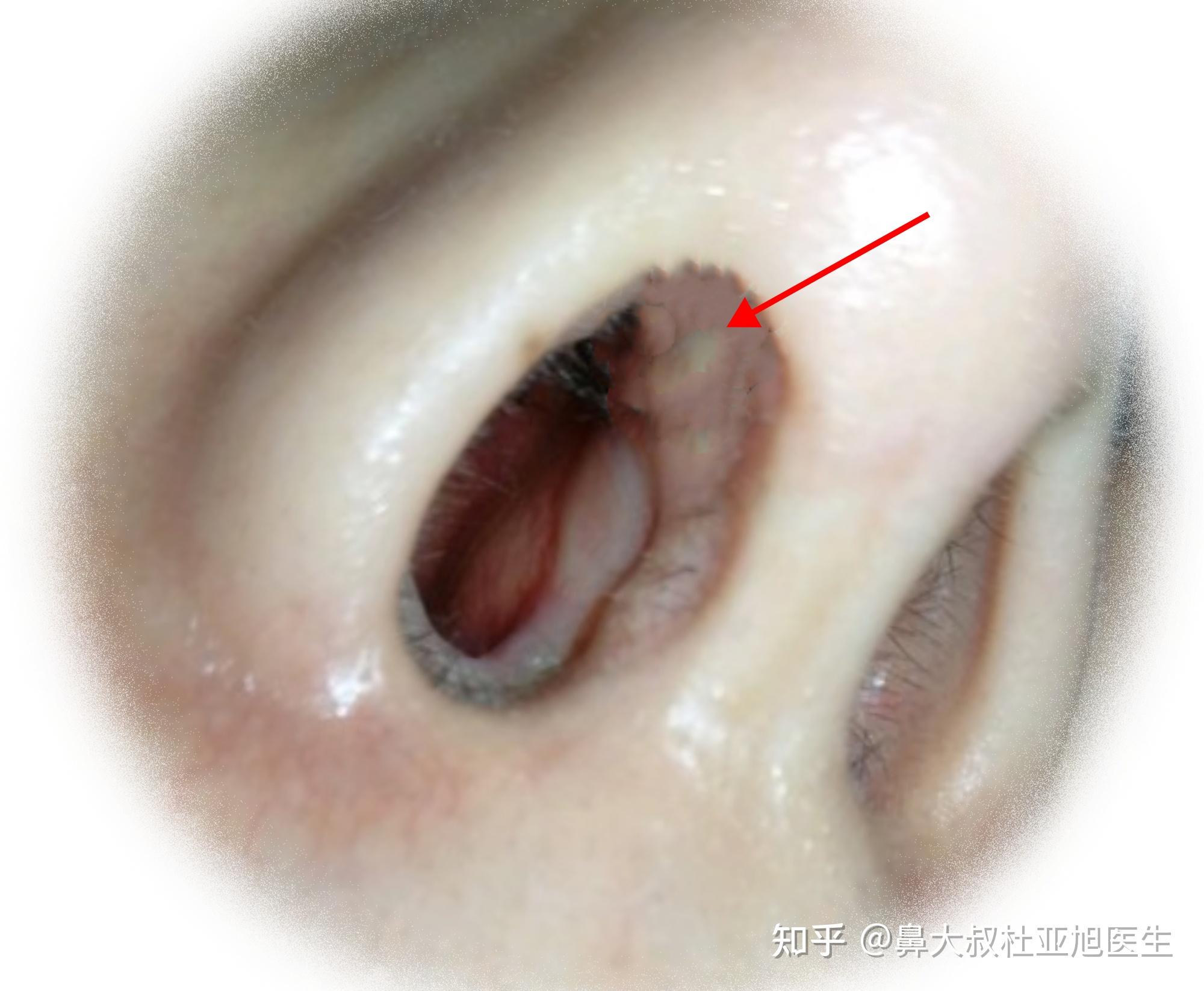 为什么有人隆鼻后鼻孔会出现白色突起物而且越来越厉害?