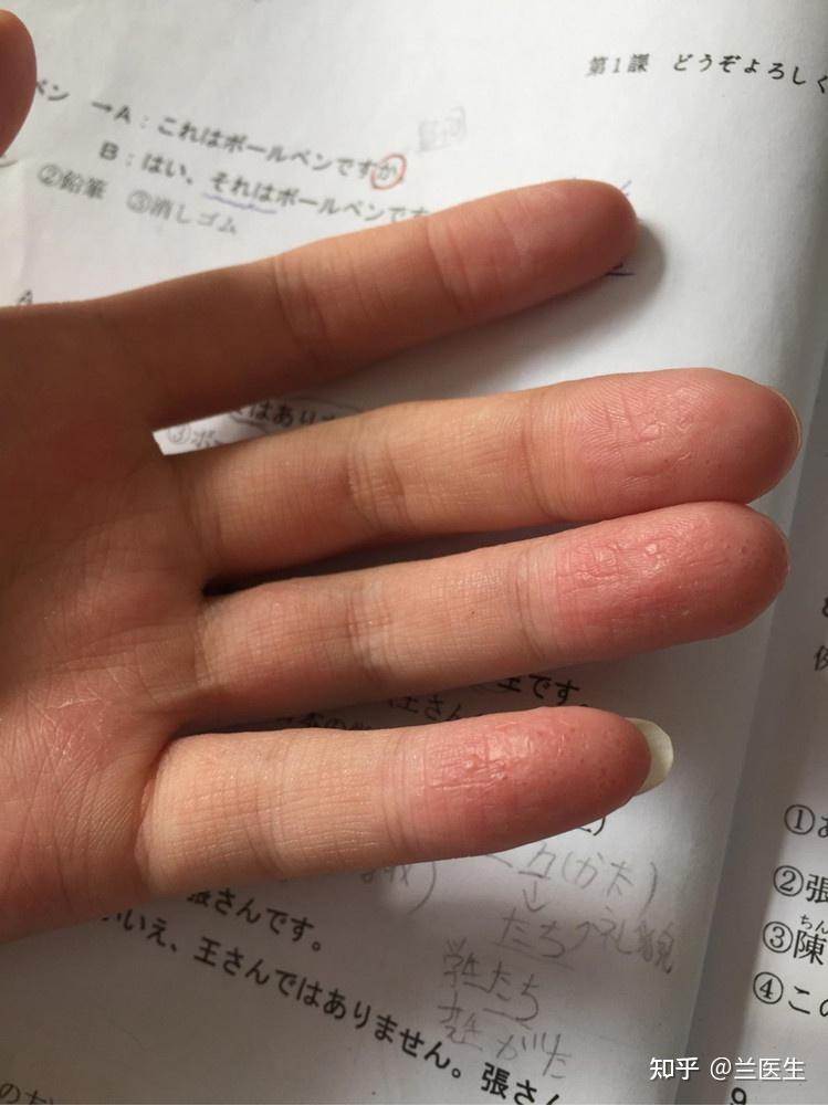 汗疱疹如何治疗最佳? - 知乎