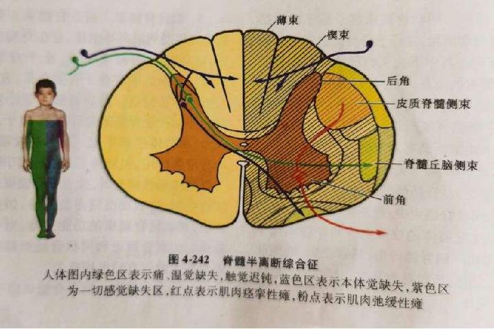 脊髓半横切 - 知乎