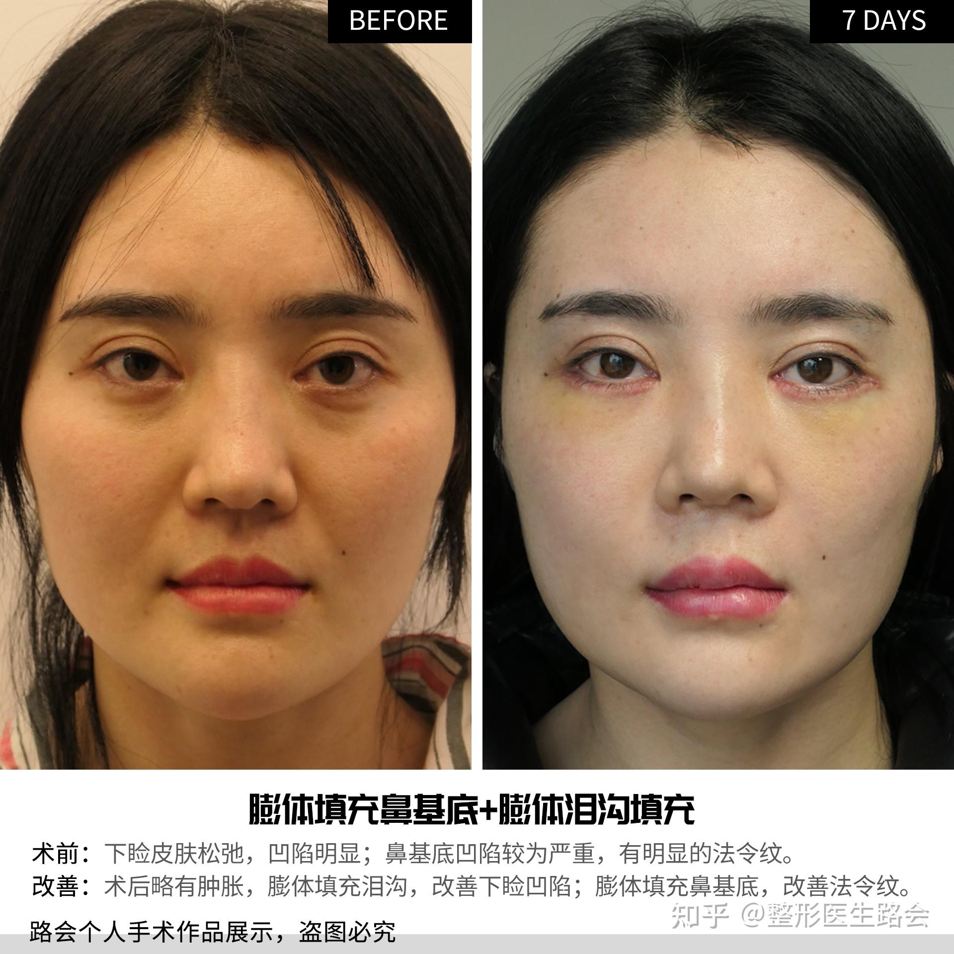 脸上出现这两道“沟”，特显老！作为过来人，跟大家谈谈3点感受 - 知乎