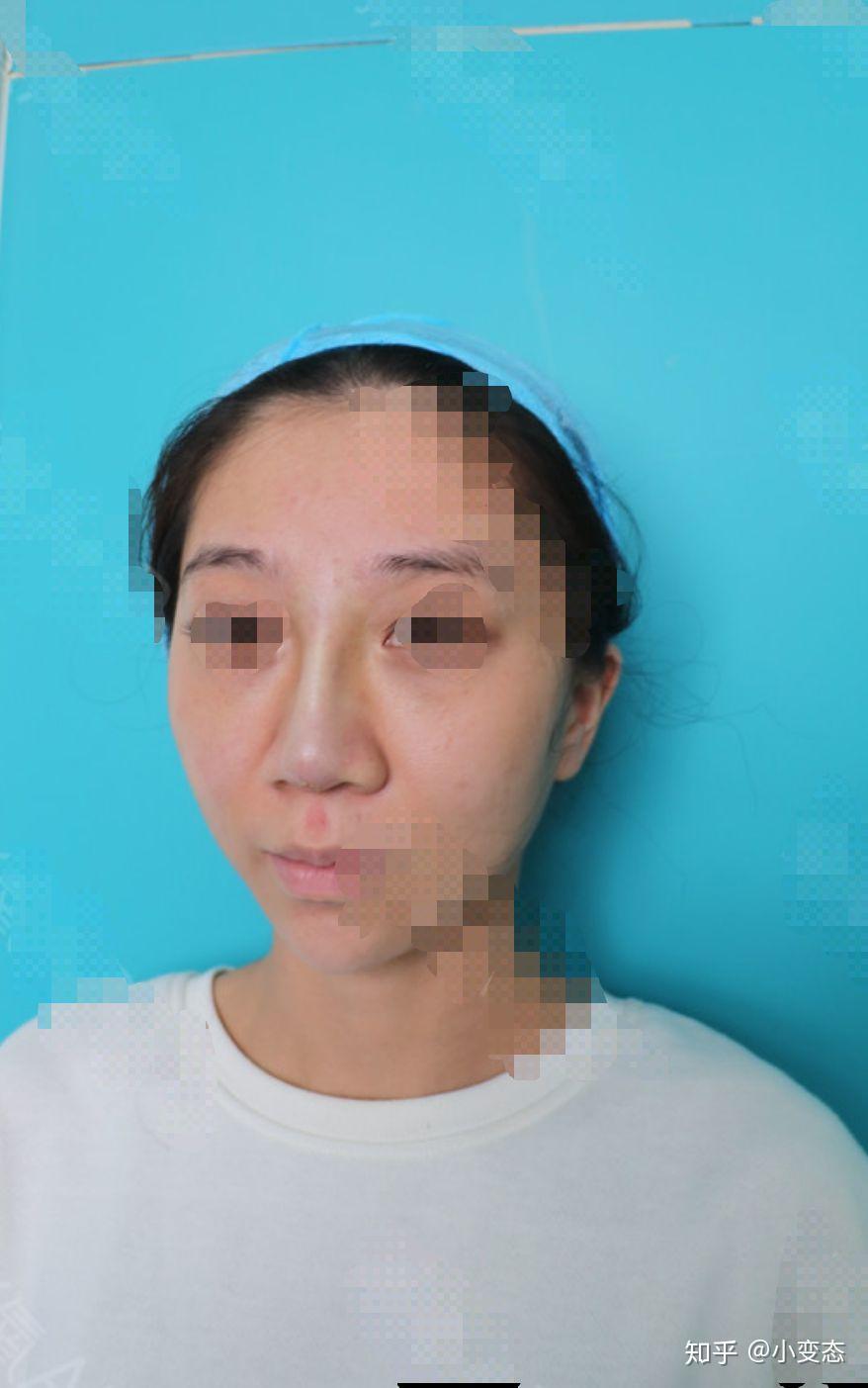 永久隆鼻可以喝酒吗_隆鼻可以永久吗_永久隆鼻可以做几次