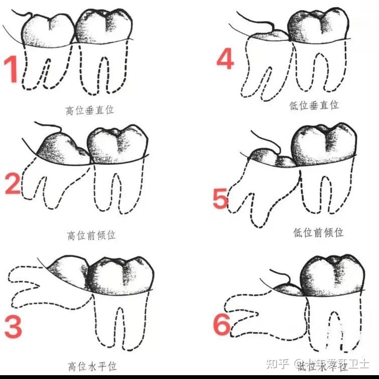 智齿会把前面牙齿挤歪吗?