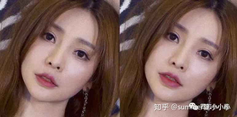 不做人中缩短术有什么其他的整容方法可以让人中缩短2mm