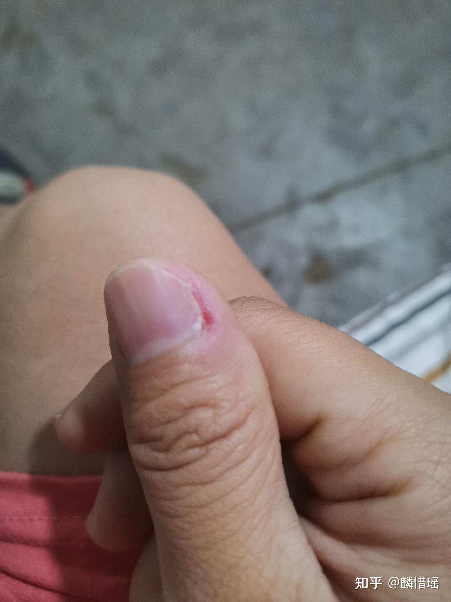 各位大神鄙人手残手指甲旁边长了死皮用指甲刀剪的时候把一些肉也剪了