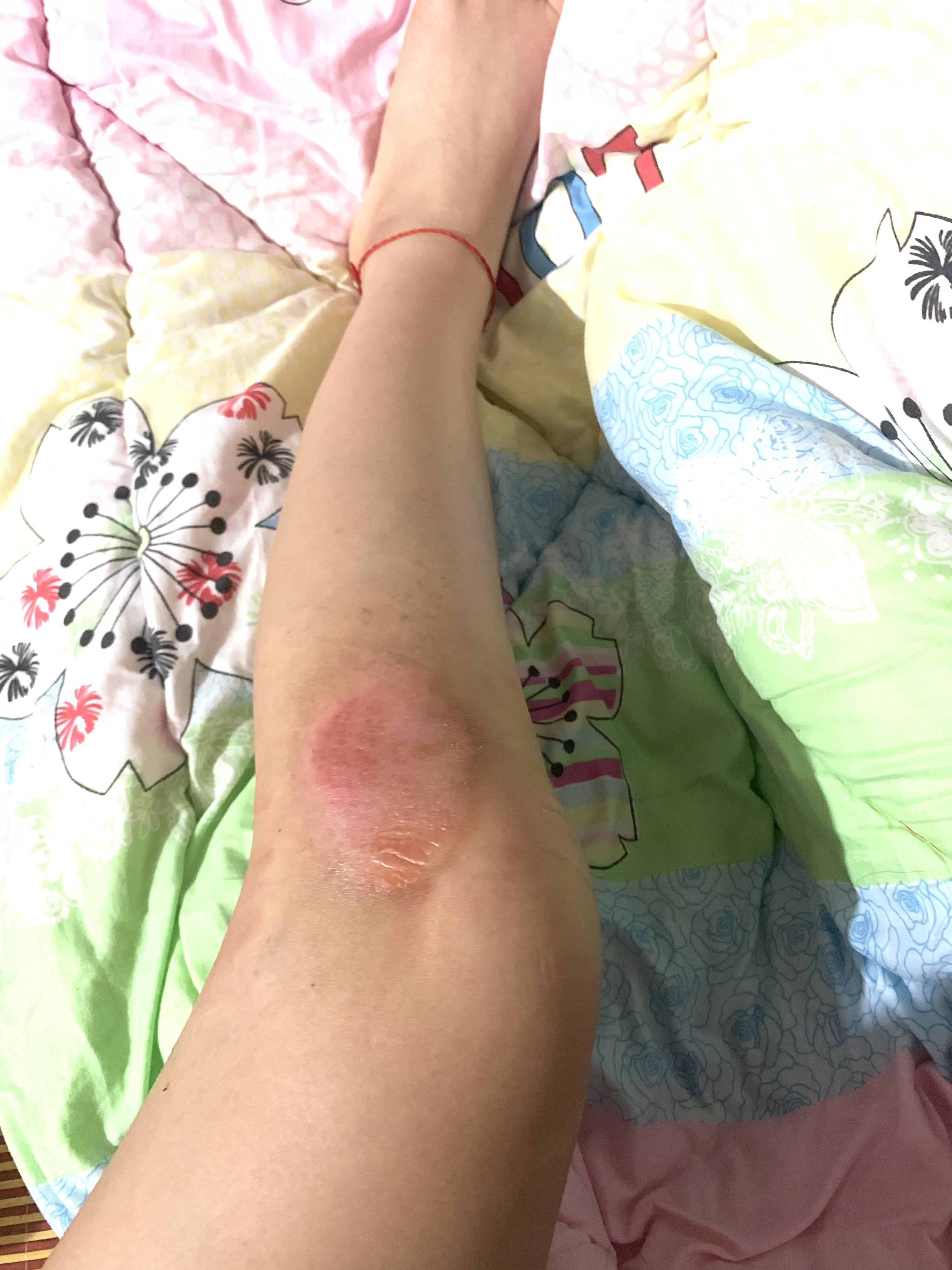 骑车摔倒擦伤怎么快速修复啊?