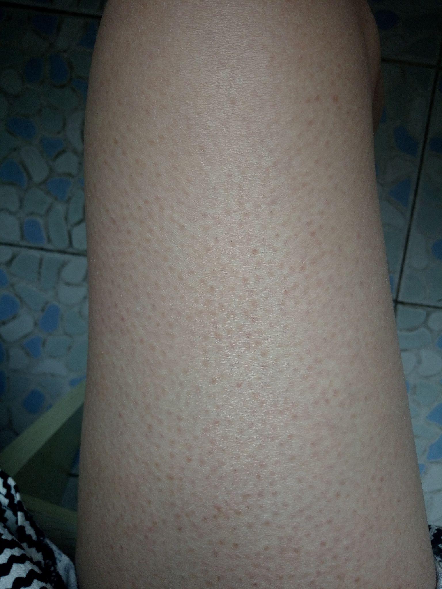 像鸡皮肤一样的光滑的疣(像鸡皮肤一样的光滑的疣体是什么)