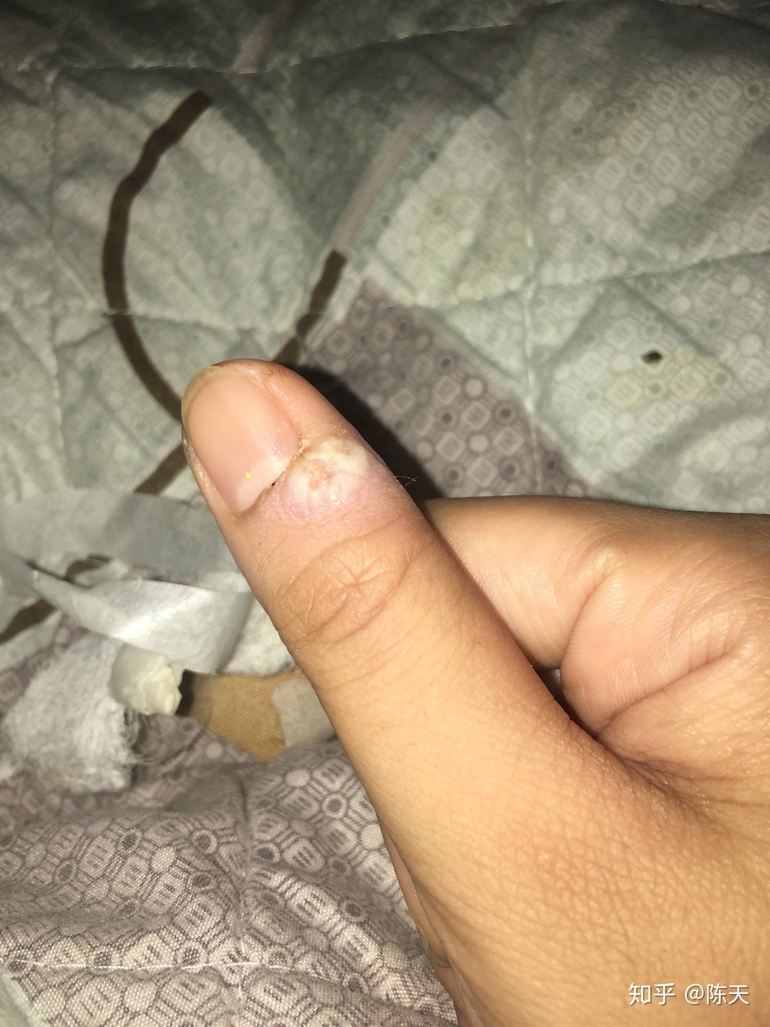 困扰了很多年的甲周疣,在右手的中指上,疣体已经占据了指甲的一半.