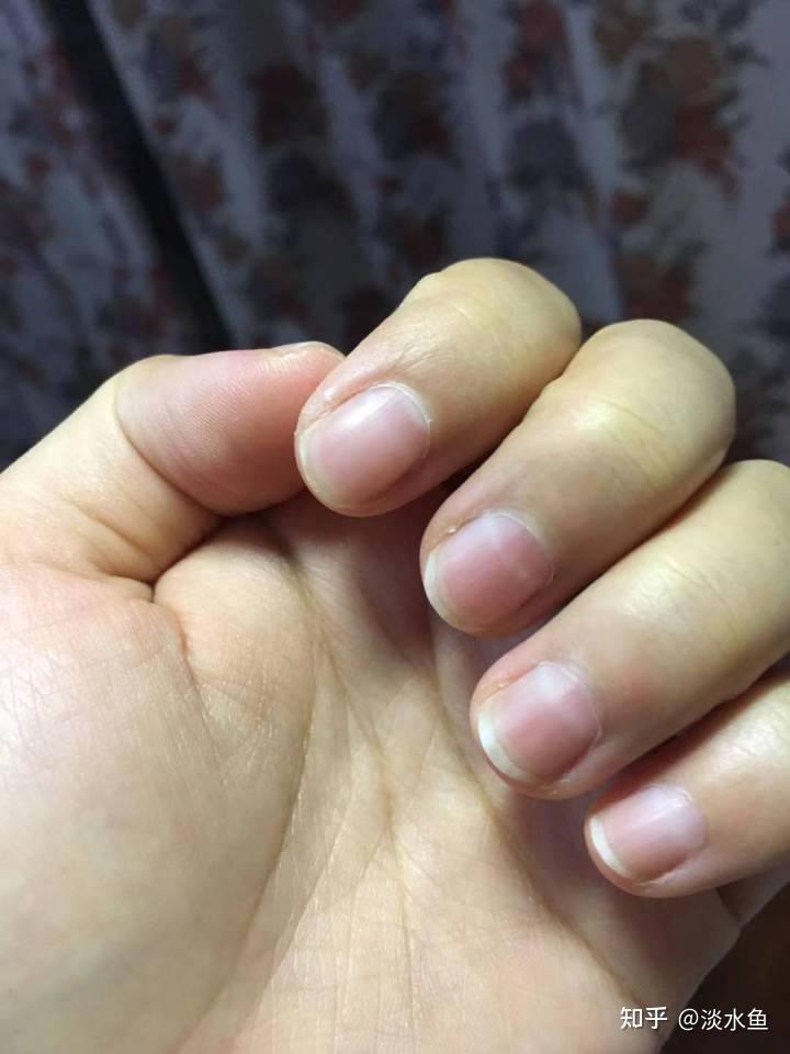 指甲出现白色横纹是什么情况