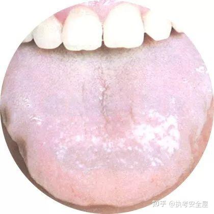 【舌诊大全】120种常见的舌苔超清彩色图谱，建议收藏！ - 知乎