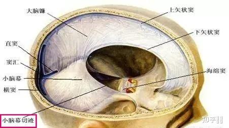 请问什么叫做"切迹"? - 知乎