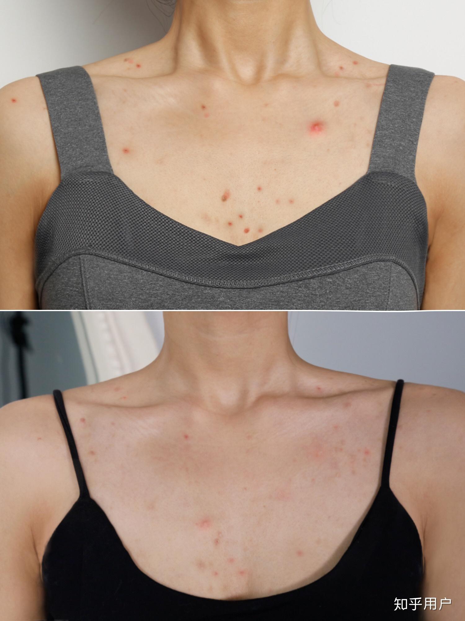 前胸后背很多痘而且很多痘印要怎么办才能改善这种状况