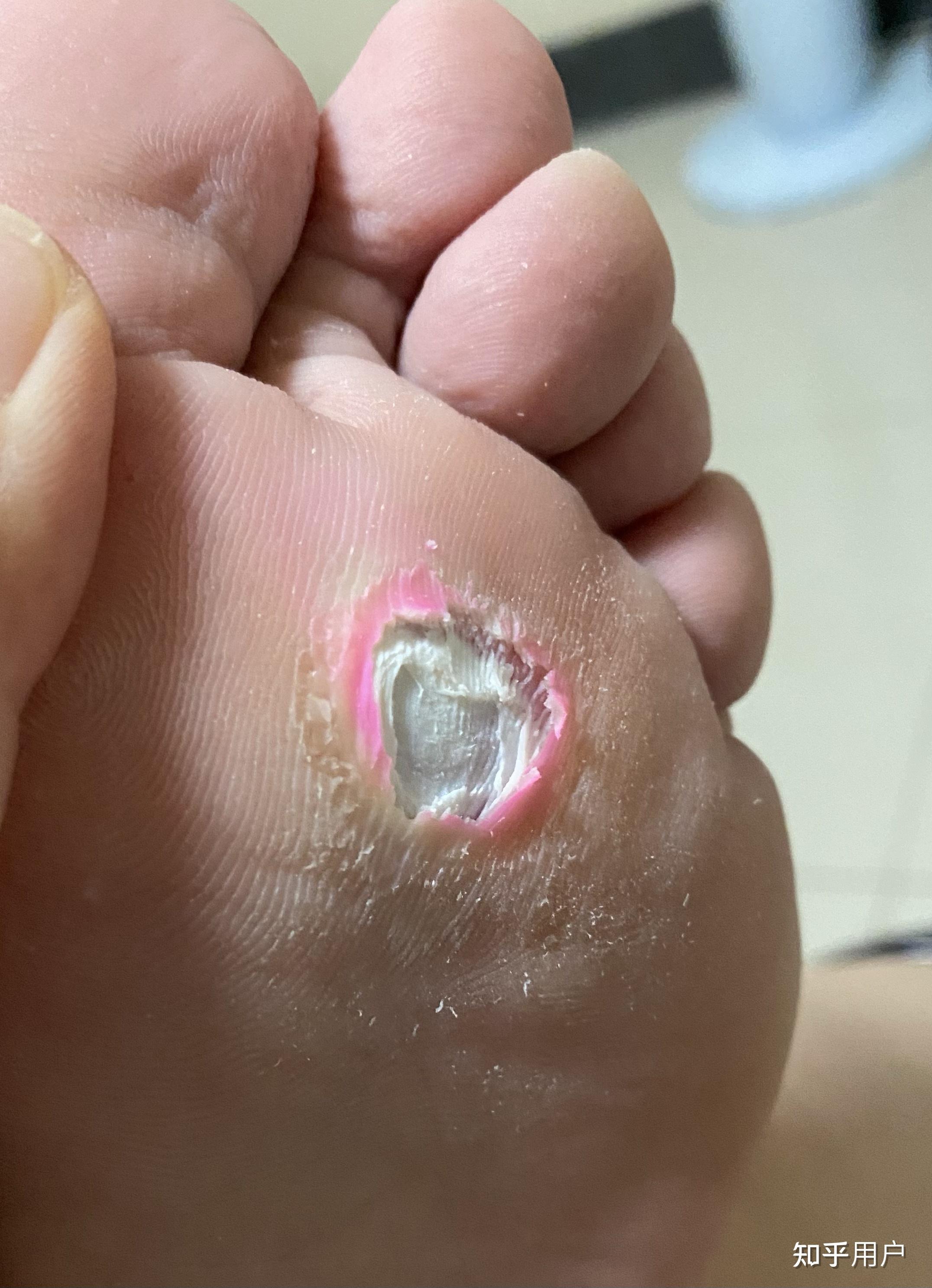 鸡眼贴贴到什么程度就不要贴了