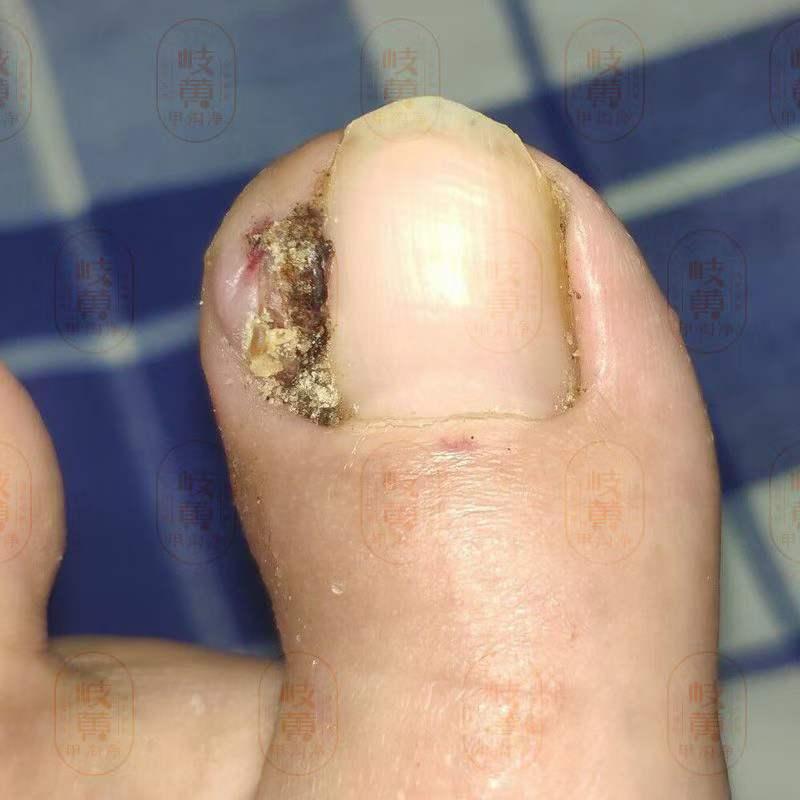 原先是甲沟炎自行剪甲后长了肉芽且越来越大怎么办