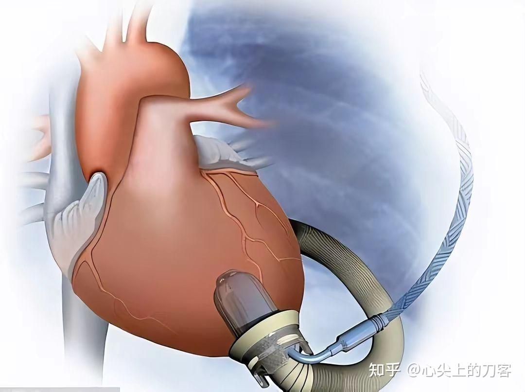 我国第三代人工心脏辅助装置推广应用,人工心脏将对相关患者带来哪些