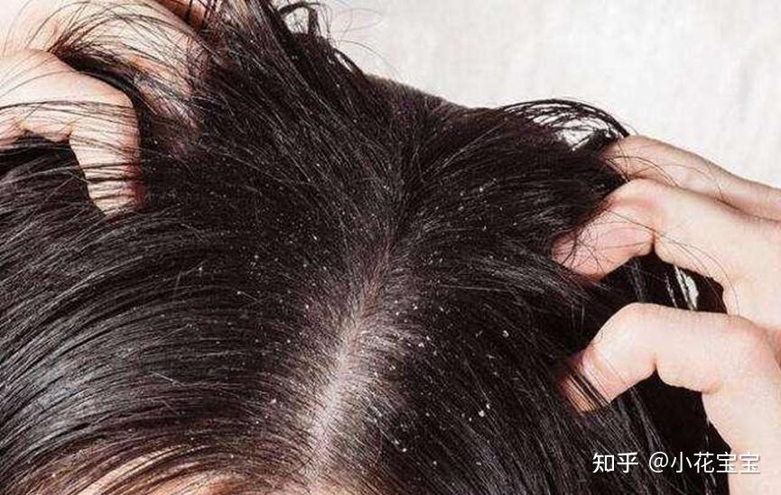 头痒还有头皮屑怎么办?14大护发指南有奇效! - 知乎