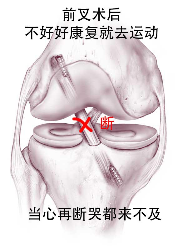 叉友注意 前交叉韧带重建手术做完后