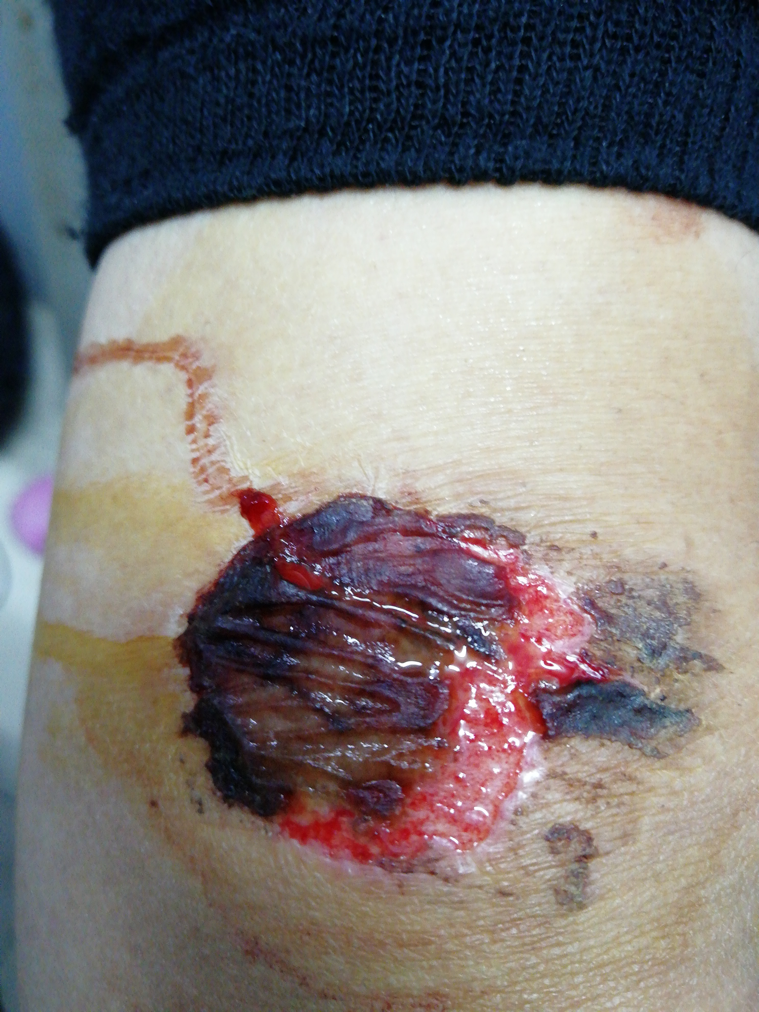 皮肤破后,流血结痂愈合是一个怎样的过程? - 知乎