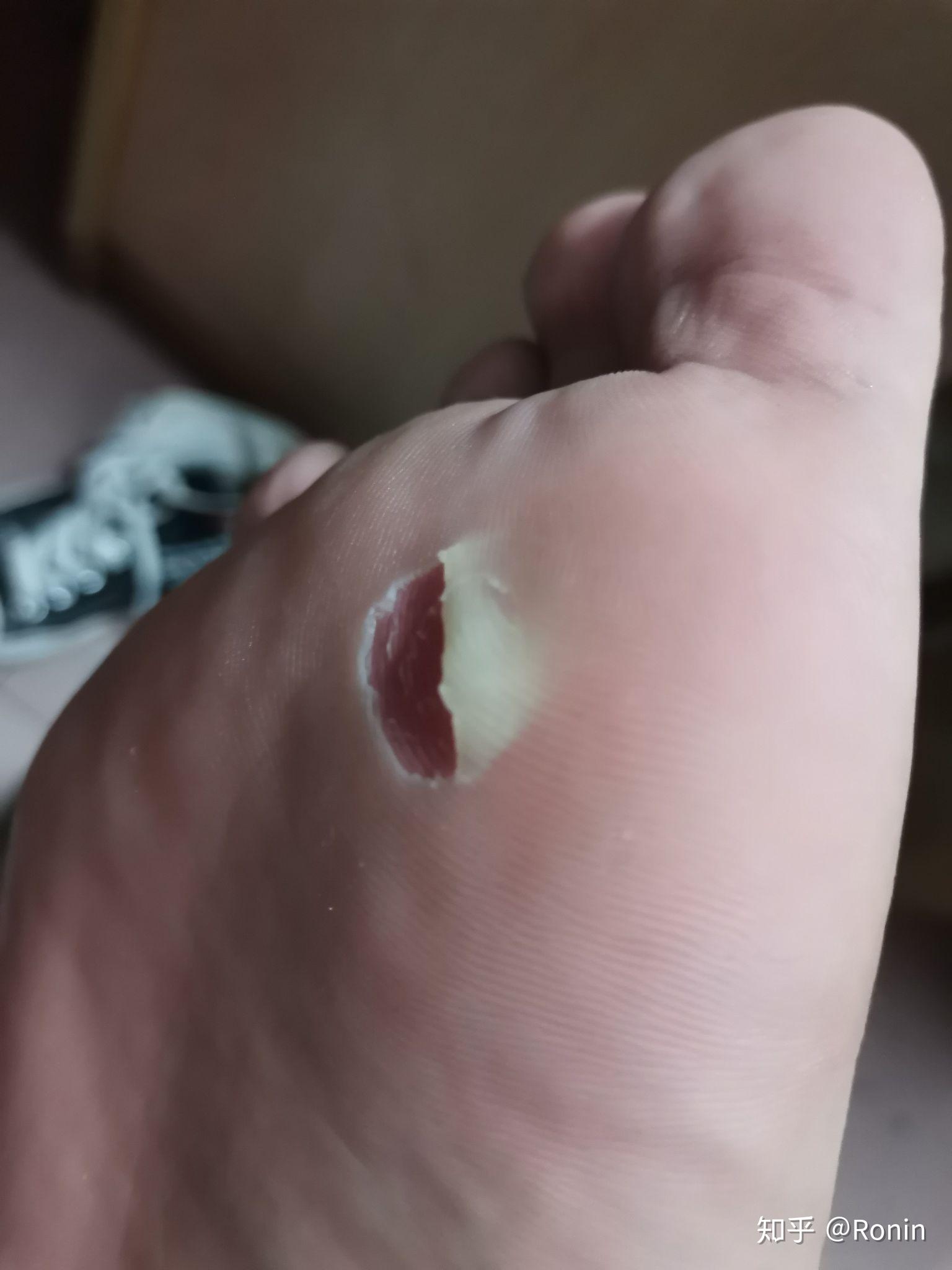 打篮球前脚掌皮容易磨破或起血泡,老茧都不能保护前脚掌的皮,这是什么