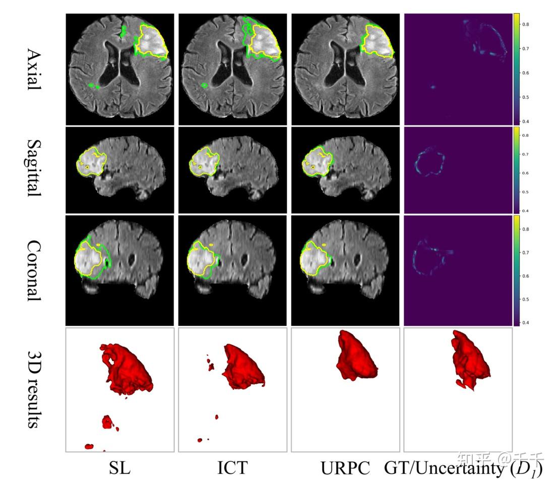 Semi-supervise d me dical image segmentation via uncertainty rectified ...