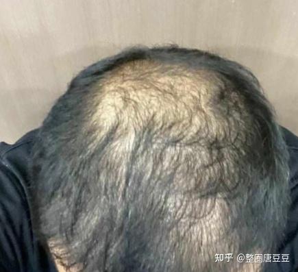 做植发前 一定要看的10条良心忠告!过来人血泪经验,避坑必看! - 知乎