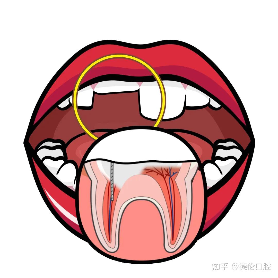 牙外伤紧急处理与后续应对,看完这篇全知道! - 知乎