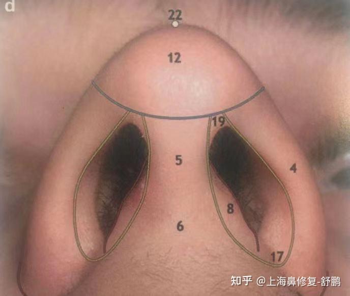请问鼻小柱有缺陷是什么意思