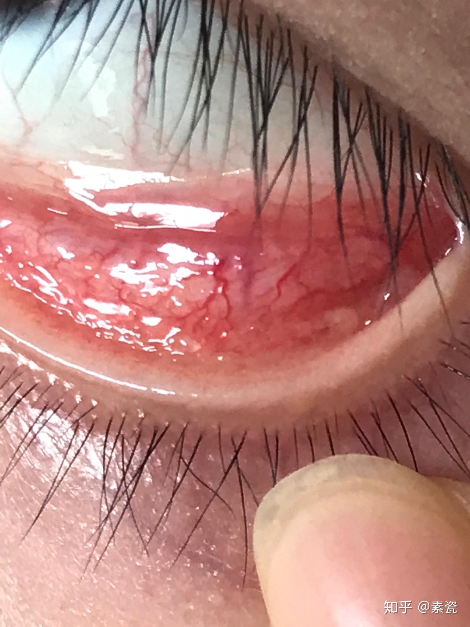 滤泡性结膜炎如何能有效治疗,之前会怕光,流眼泪眼干涩疼痛,现在这些