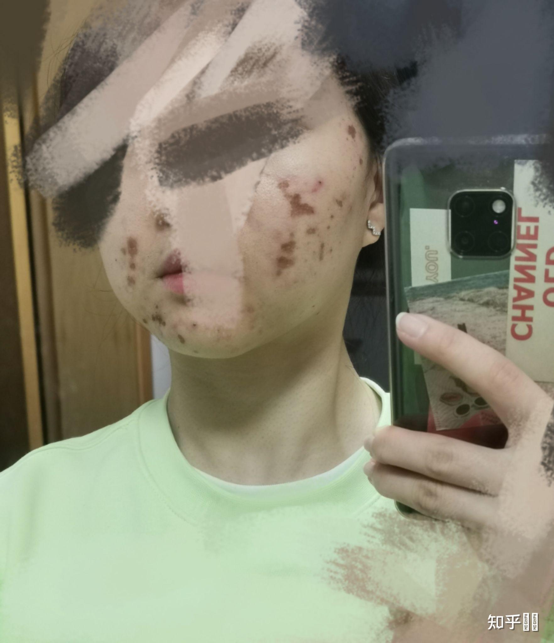 果酸灼伤是什么体验?