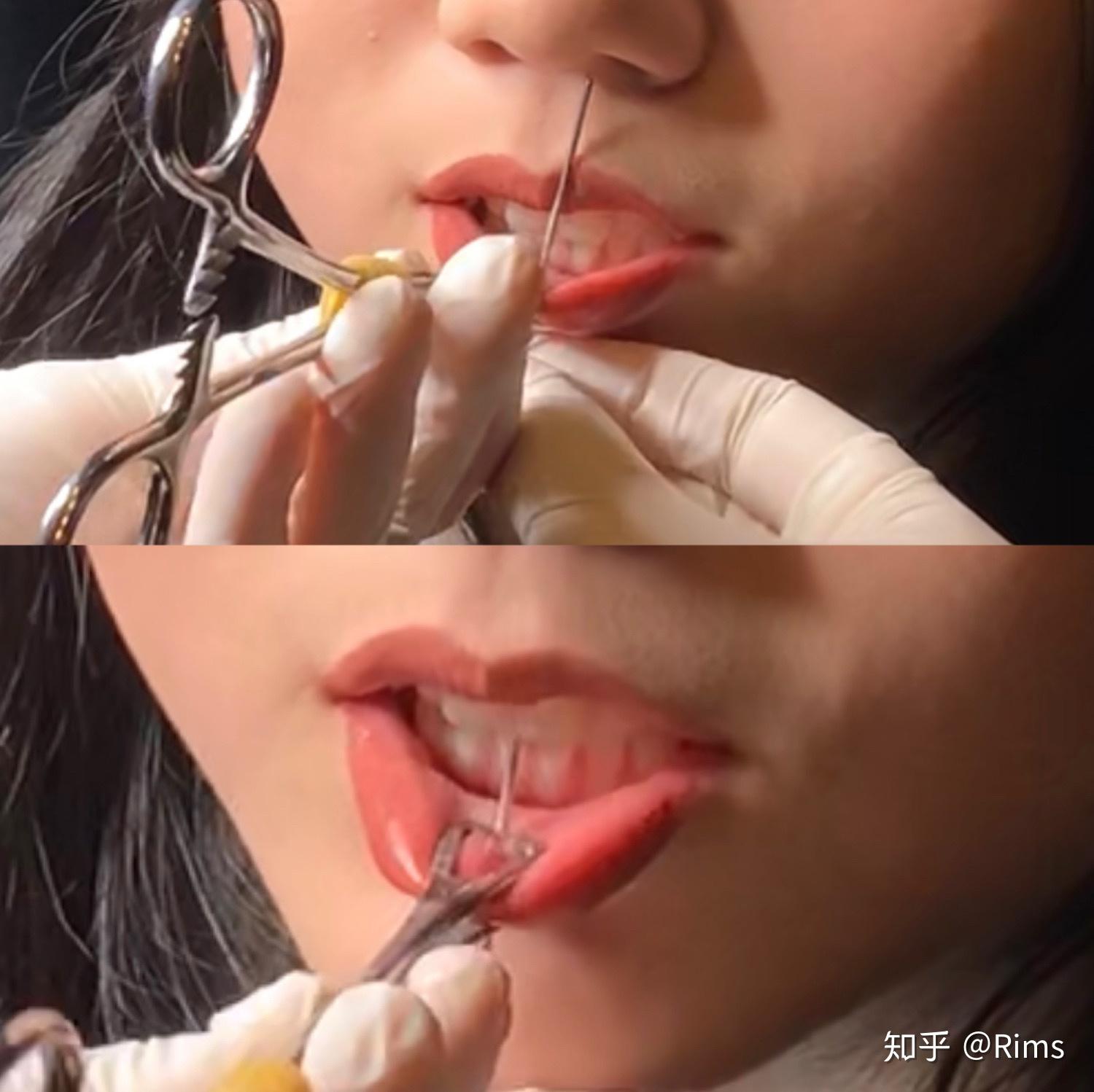 我想看看唇钉摘下后是什么样子的
