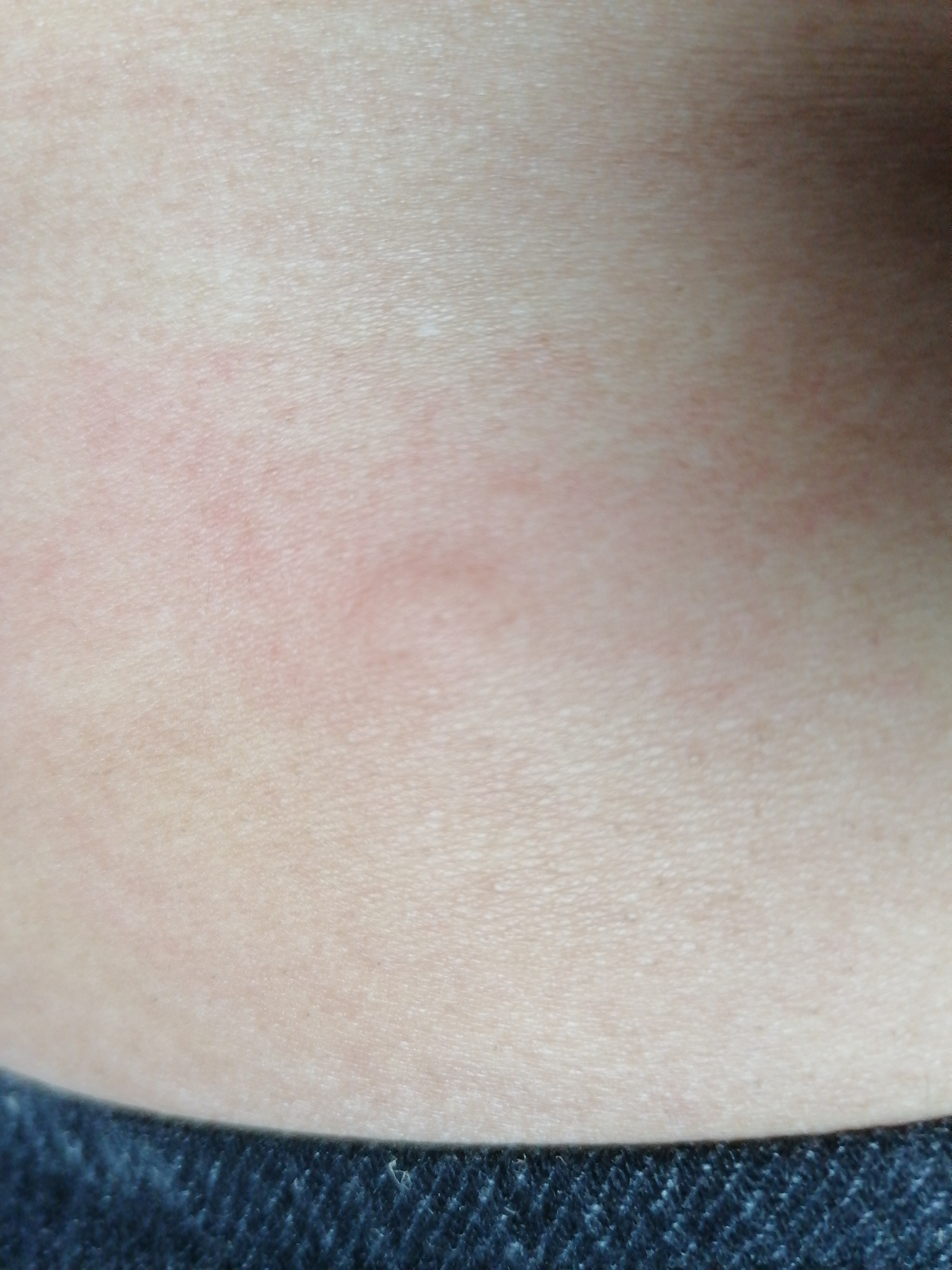 头孢过敏是什么症状和体验?