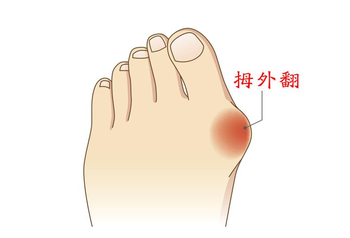 拇囊炎的症状是什么?李茂盛科普 - 知乎
