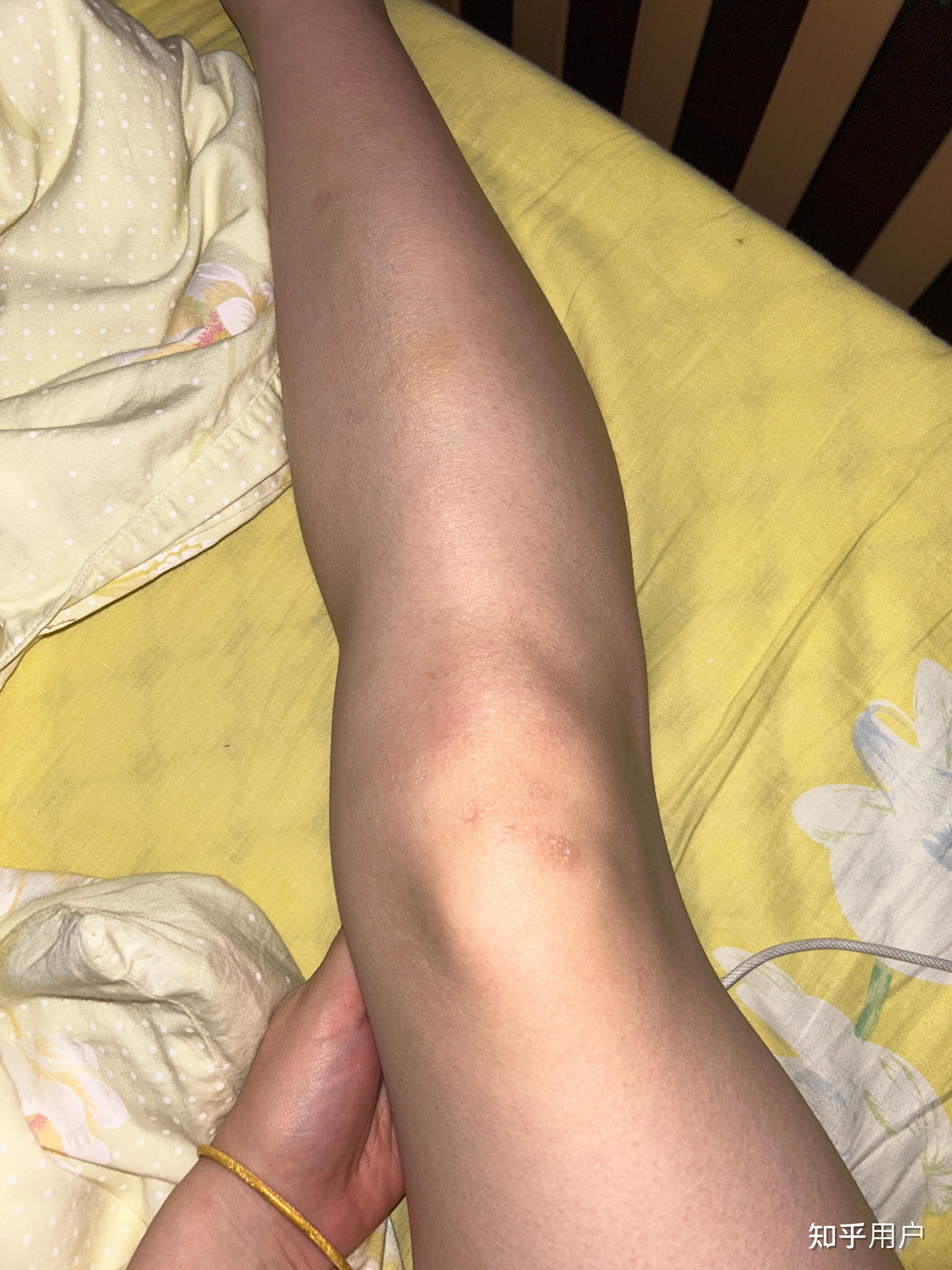 xo型腿是骨头弯了吗?