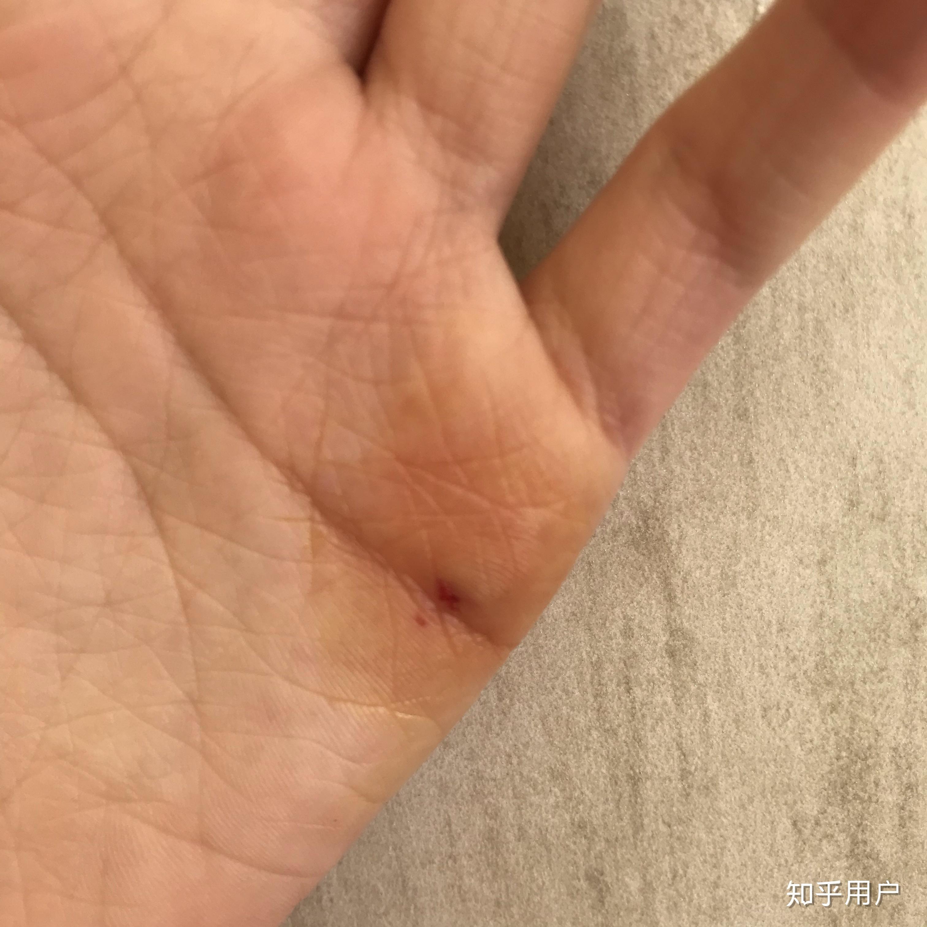 被不锈钢水果刀的刀尖扎伤手,要不要打破伤风针? - 知乎