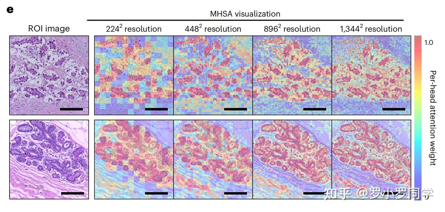 Nature Medicine病理AI汇总｜UNI：一种用于计算病理学的通用自监督基础模型·顶刊精析·24-10-31 - 知乎