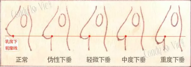 如何直观通俗说明纺锤胸和胸下垂的区别