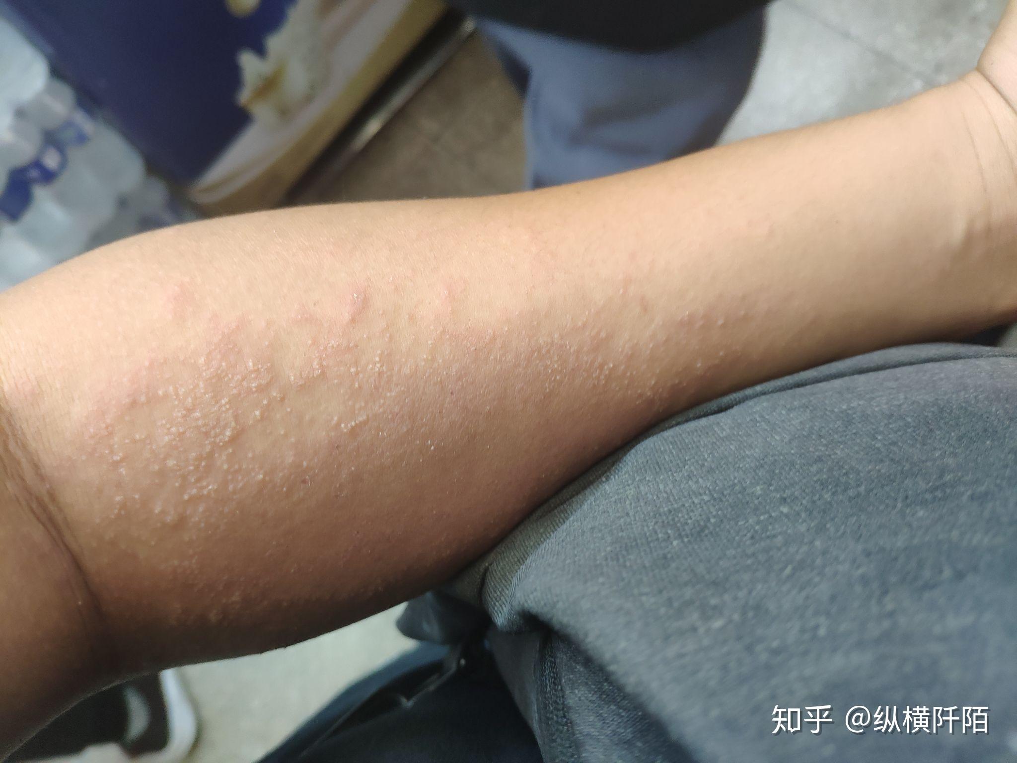 酒精过敏的人喝多了会怎么样?