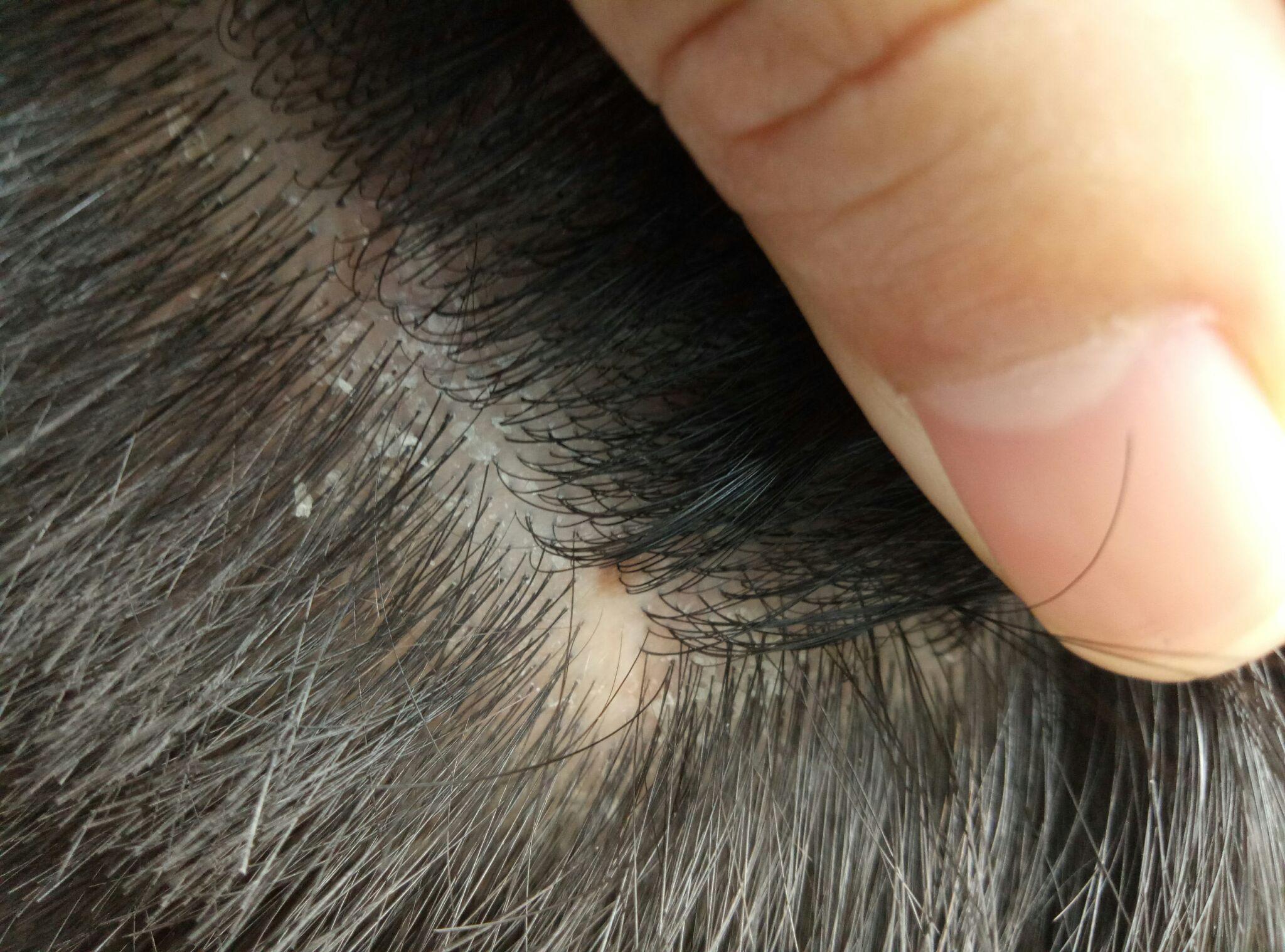 请问头部银屑病应该如何治疗